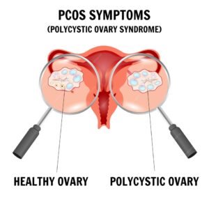 Comparison of normal ovary and ovary with polycystic ovary syndrome (PCOS).